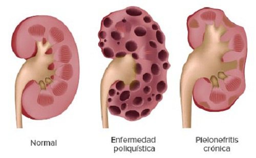 Enfermedades-en-los-riñones-500x308